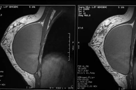 undeveloped tits|Tubular breasts: Symptoms, causes, and augmentation